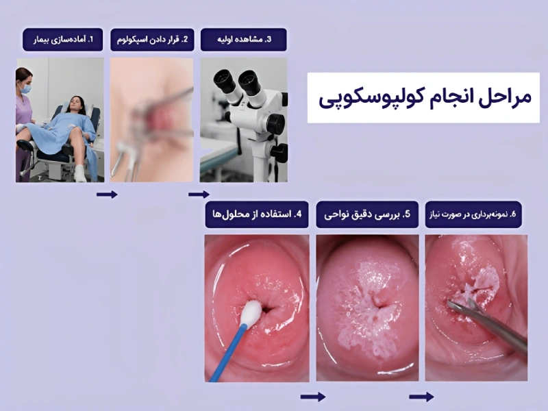 مراحل کولپوسکوپی