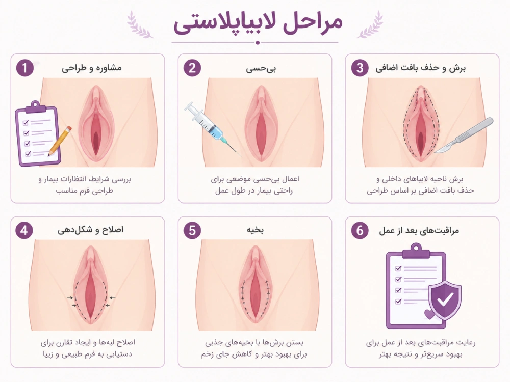 لابیاپلاستی در نیشابور